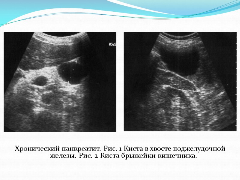 Хронический панкреатит. Рис. 1 Киста в хвосте поджелудочной железы. Рис. 2 Киста брыжейки кишечника.